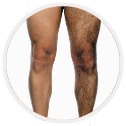 leg-hair-removal-Toronto