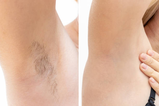 laser hair removal toronto